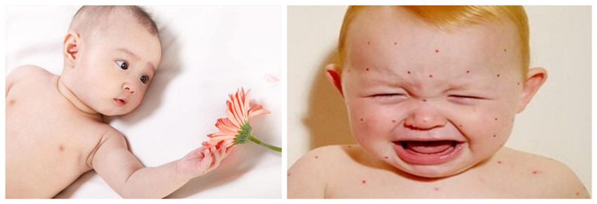 兒童濕疹反反復(fù)復(fù)，您有在家安裝家用除濕產(chǎn)品嗎？